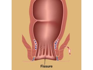 Expert Fissure Surgeon in Kolkata for Lasting Relief