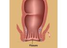 Expert Fissure Surgeon in Kolkata for Lasting Relief