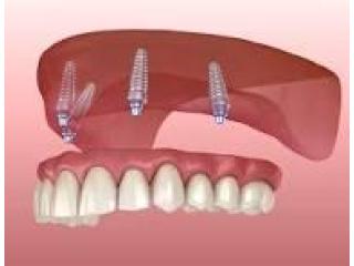 Denture Implants in Fitchburg MA | Secure Tooth Replacement at Whalom Dental
