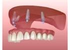  Denture Implants in Fitchburg MA | Secure Tooth Replacement at Whalom Dental