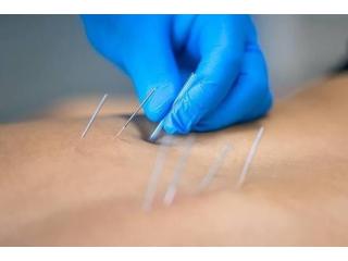 Dry Needling Services in Gurgaon – Expert Pain Relief & Muscle Recovery