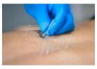 Dry Needling Services in Gurgaon – Expert Pain Relief & Muscle Recovery