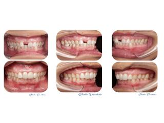 The Cost of Dental Implants in Nepal