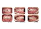 The Cost of Dental Implants in Nepal