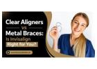 Clear Aligners vs Metal Braces: Is Invisalign Right for You?