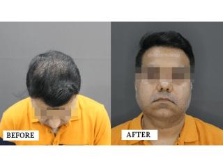Experienced Hair Transplant Doctor in Gurgaon - SB Trichology