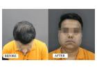 Experienced Hair Transplant Doctor in Gurgaon - SB Trichology