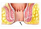 Expert Fissure Surgeon in Kolkata for Advanced Care