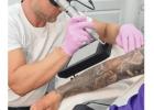 Laser Tattoo Removal Birmingham | Expert Treatments at Bianco Beauty