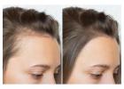 Scalp Micropigmentation Near Vancouver WA - Natural-Looking Hair Density Solutions