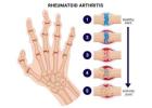 Rheumatoid Arthritis Treatment in Gurgaon | Expert Physiotherapy for Joint Pain Relief