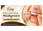 Fixing Moderate Misalignment with Invisalign Clear Aligners