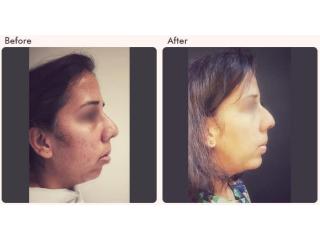 Chin Augmentation in Delhi - Dr Rajat Gupta