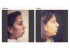 Chin Augmentation in Delhi - Dr Rajat Gupta