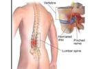 Spinal Rehabilitation in Gurgaon | Expert Spine Pain & Recovery Physiotherapy