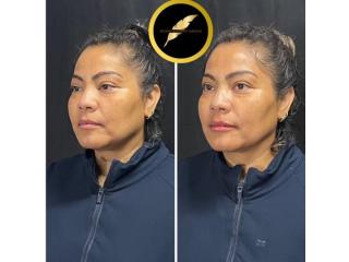 Facelift in Los Angeles