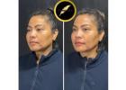 Facelift in Los Angeles