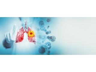 Lung Cancer Treatment in Delhi