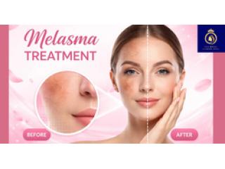 Trusted Clinic for the Best Melasma Treatment in Thane | DNA Royal.