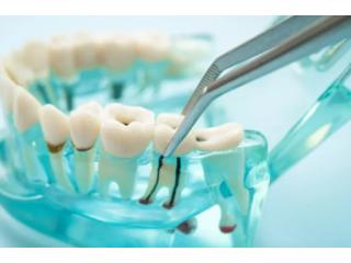 Expert Surgical Tooth Extraction | Rosedale Smiles