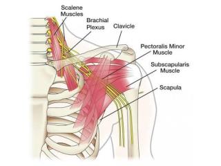 Brachial Plexus Injury Treatment in Gurgaon | Expert Physiotherapy & Nerve Rehabilitation