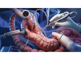 Precision Endoscopy Care by the Best Endoscopist Ludhiana