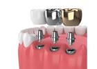 Invisalign Treatment Madura Dental Clinic