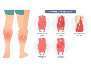 Calf Strain Treatment in Gurgaon | Expert Physiotherapy for Fast Recovery