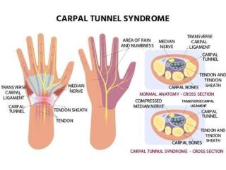 Carpal Tunnel Syndrome Treatments in Gurgaon | Expert Physiotherapy for Wrist & Hand Pain