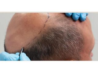 Hair Transplant Near DLF Phase Area, Gurgaon