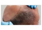Hair Transplant Near DLF Phase Area, Gurgaon