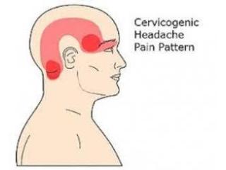 Cervicogenic Headaches Treatment in Gurgaon | Expert Physiotherapy for Neck-Related Headaches