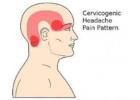 Cervicogenic Headaches Treatment in Gurgaon | Expert Physiotherapy for Neck-Related Headaches