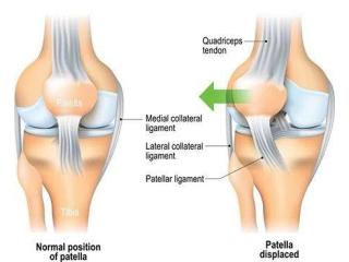 Chondromalacia Patella Treatment in Gurgaon | Expert Knee Pain Physiotherapy & Rehabilitation