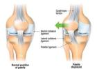 Chondromalacia Patella Treatment in Gurgaon | Expert Knee Pain Physiotherapy & Rehabilitation