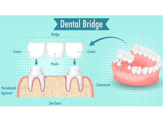Dental Bridges Arizona – Restore Missing Teeth for Just $699 Per Unit