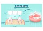 Dental Bridges Arizona – Restore Missing Teeth for Just $699 Per Unit