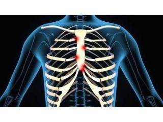 Costochondritis Physiotherapy Treatment in Gurgaon | Expert Physiotherapy for Chest Wall Pain Relief