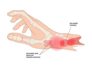 De Quervain Tenosynovitis Treatment in Gurgaon | Expert Physiotherapy for Wrist & Thumb Pain