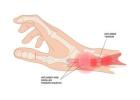 De Quervain Tenosynovitis Treatment in Gurgaon | Expert Physiotherapy for Wrist & Thumb Pain