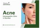 Safe Acne Homeopathy Treatment for Clear Skin and Confidence
