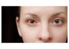 Better Eye Comfort With Dry Eye Treatment in Faridabad