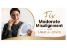 Fix Moderate Misalignment with Clear Aligners