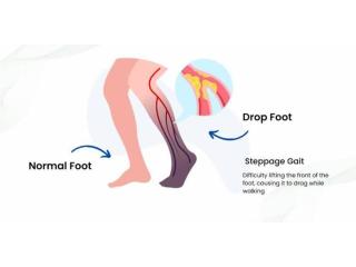 Foot Drop Treatment in Gurgaon | Expert Physiotherapy for Faster Recovery