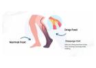 Foot Drop Treatment in Gurgaon | Expert Physiotherapy for Faster Recovery
