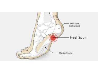 Calcaneal Spur Treatment in Gurgaon | Expert Heel Pain Physiotherapy