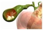 Dr. Purnendu Roy – Best Doctor for Gallbladder Stone Surgery in Kolkata