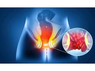 Advanced Fistula Treatment for Better Recovery in Kolkata
