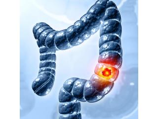 Expert GI Cancer Treatment in Noida | Dr. Manish Singhal