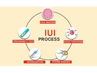 IUI Treatment in Delhi - Dr Rhythm Gupta
